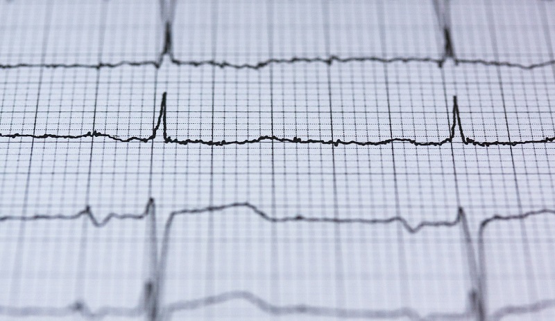 New AI tool beats standard approaches for detecting heart attacks